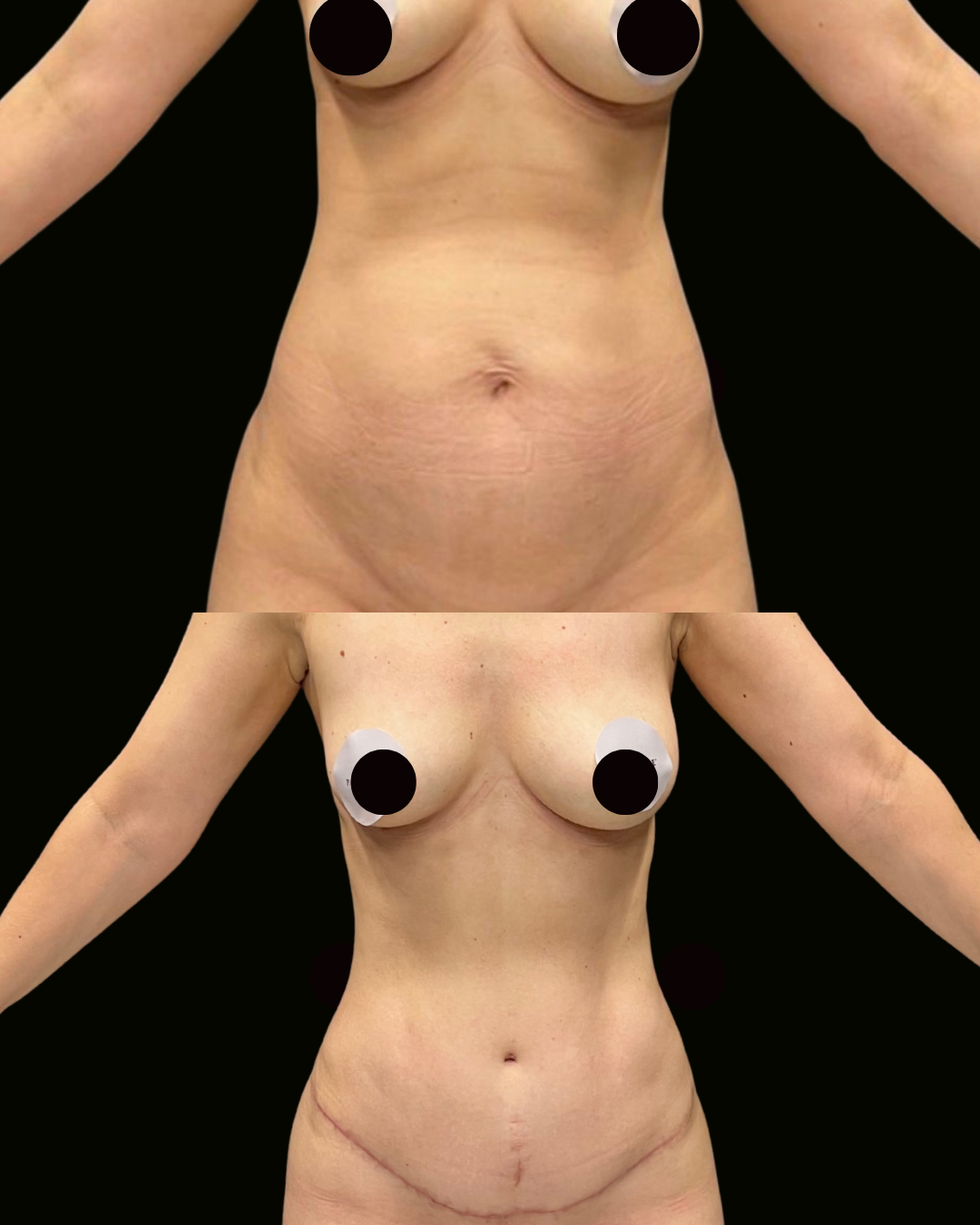 Registro autorizado de paciente do Dr. Daniel Botelho, Lipoabdominoplastia