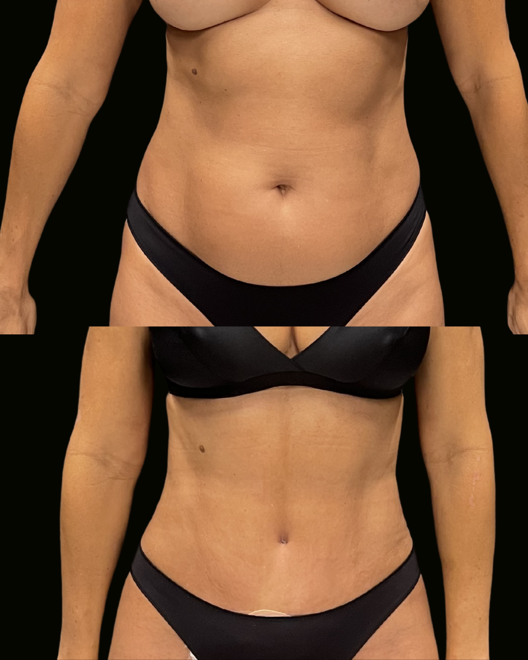 Registro autorizado de paciente do Dr. Daniel Botelho, Lipoabdominoplastia