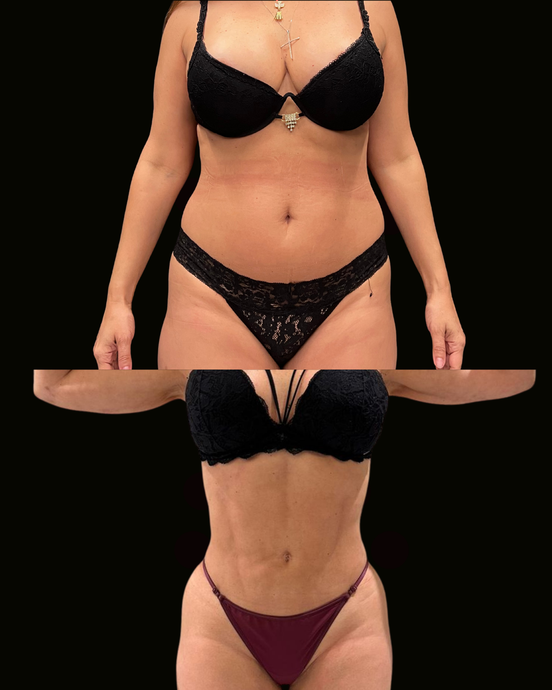 Registro autorizado de paciente do Dr. Daniel Botelho · Lipo HD feminina