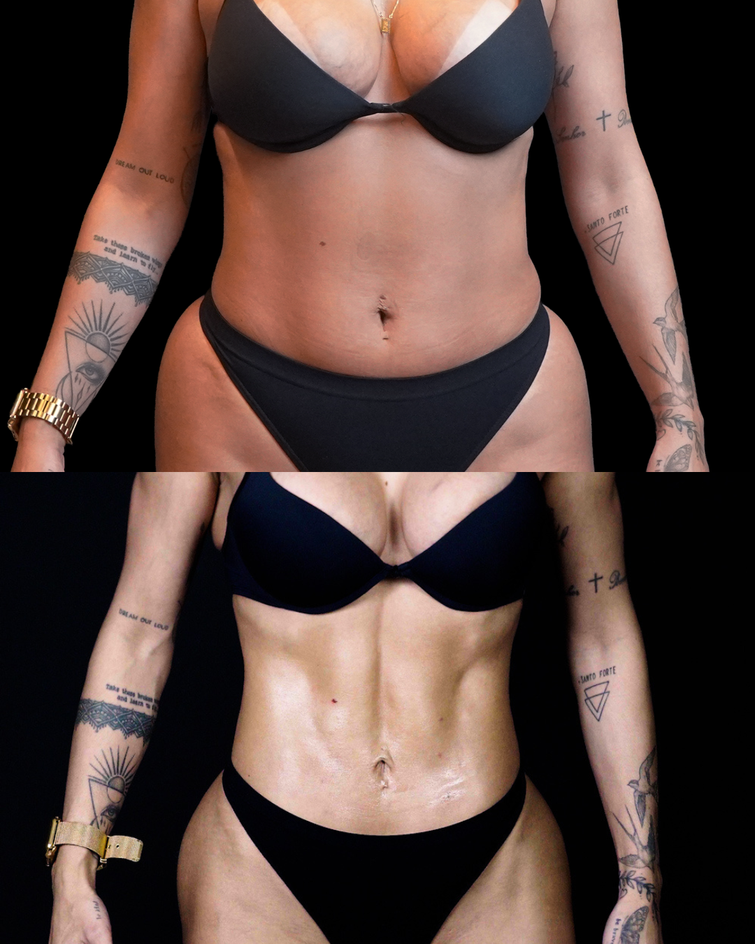 Registro autorizado de paciente do Dr. Daniel Botelho · Lipo HD feminina