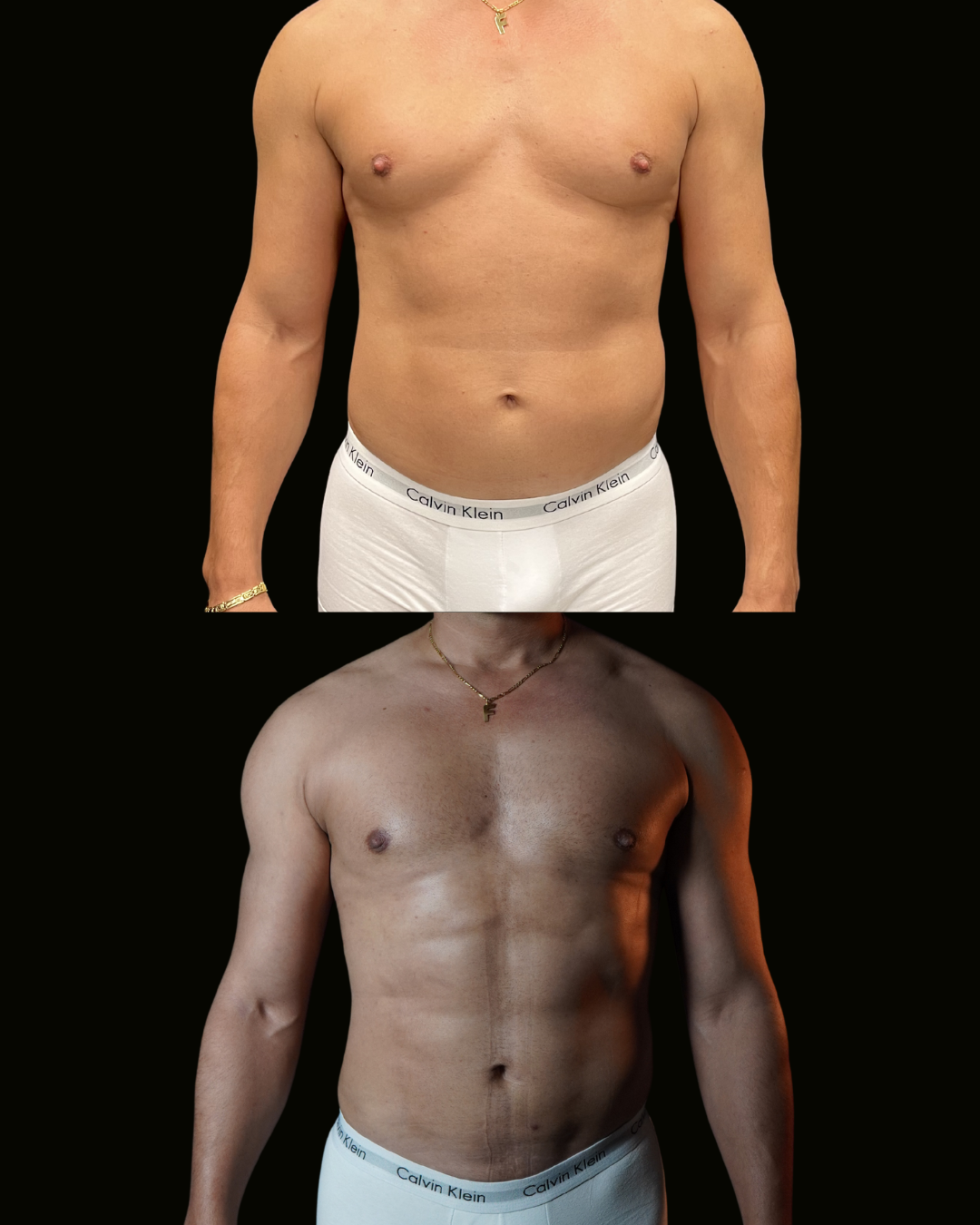 Registro autorizado de paciente do Dr. Daniel Botelho · Lipo HD masculina